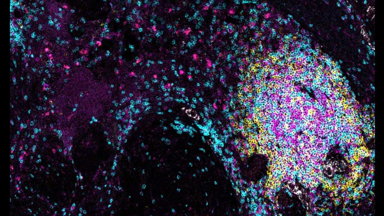 Unas estructuras similares a los ganglios linfáticos provocan la muerte de los tumores cancerosos