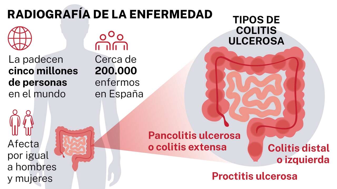 Llega a España una nuevo tratamiento para pacientes con colitis ulcerosa apto para adolescentes