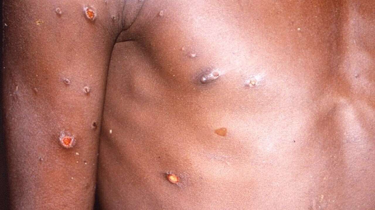 Emergencia por la mpox: qué tienes que hacer si te diagnostican viruela del mono