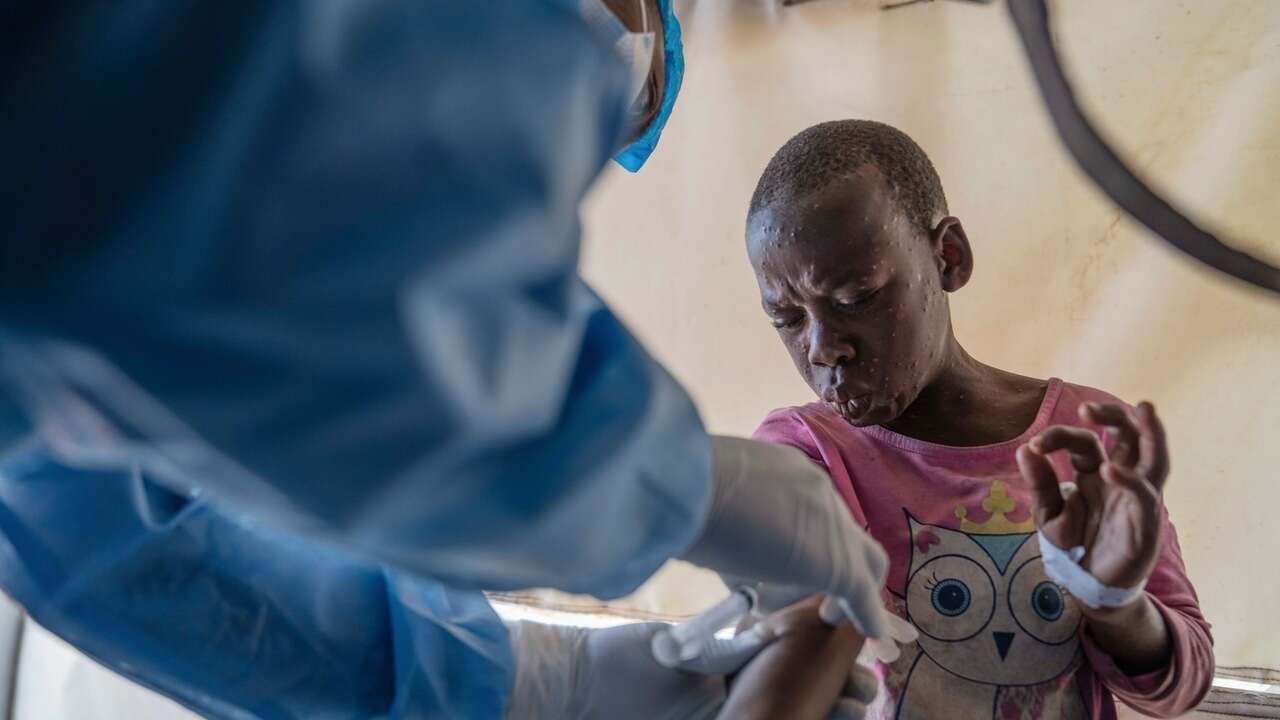 Los casos de mpox en África siguen al alza, según la OMS