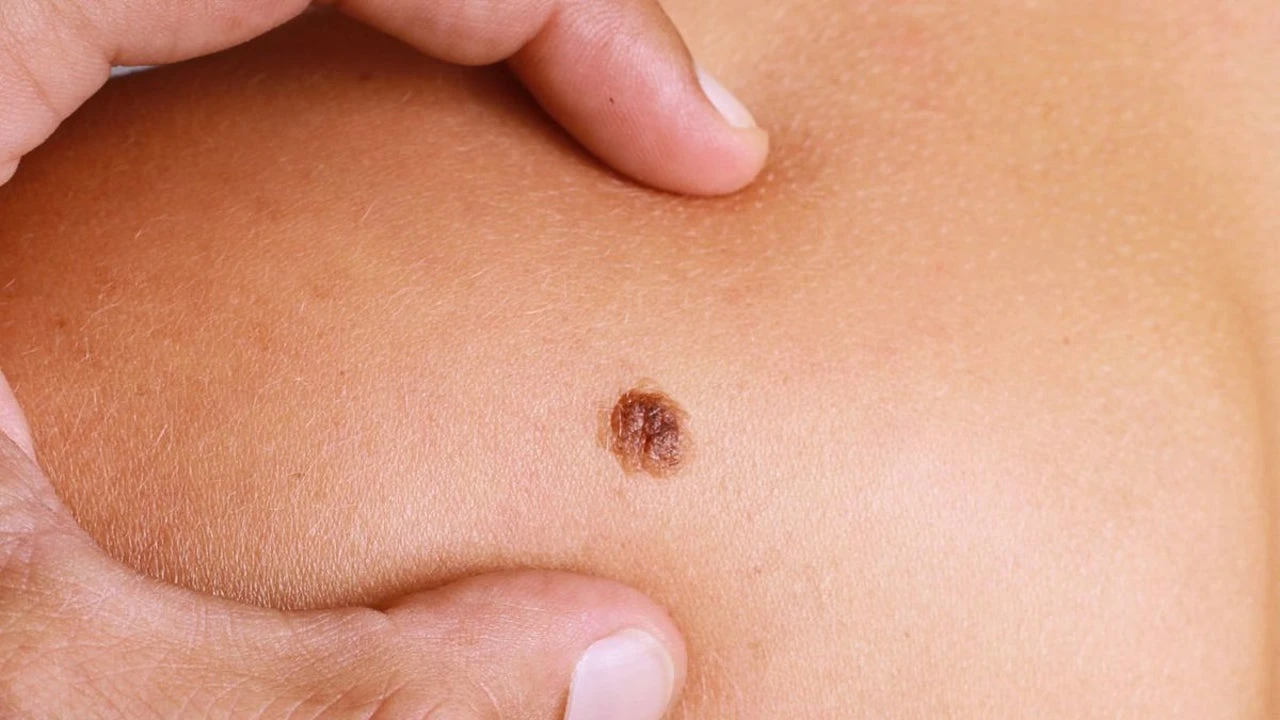 Las diferencias entre un lunar sano y uno cancerígeno: las claves para detectar el cáncer más agresivo que no para de aumentar en España