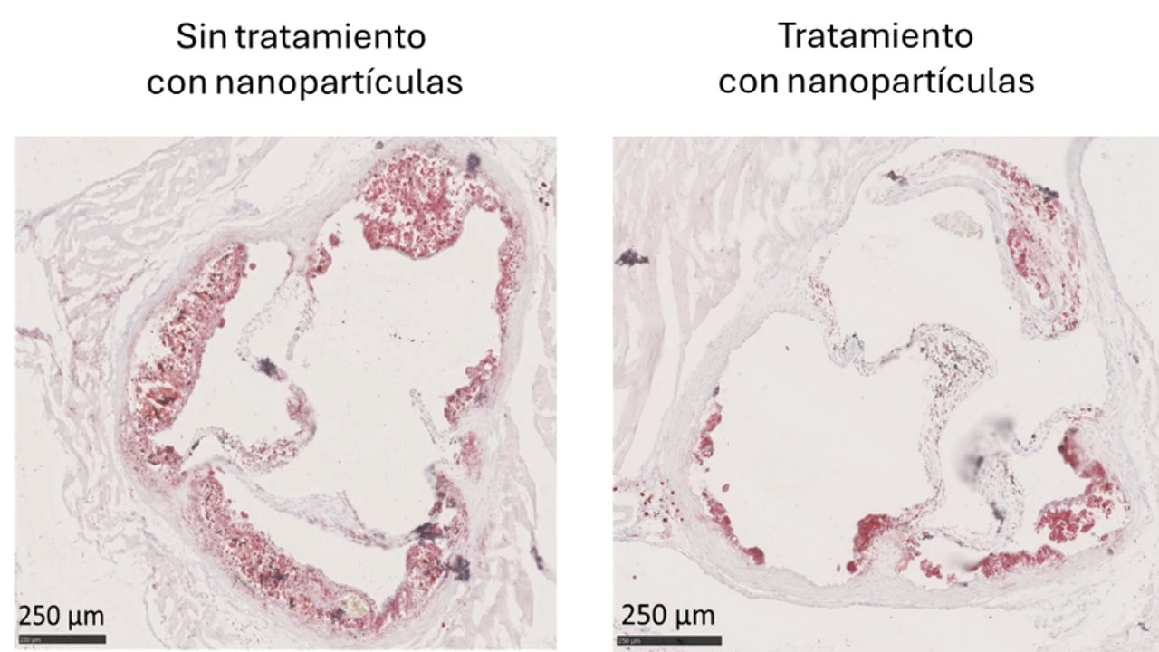 Investigadores españoles desarrollan un tratamiento para frenar la acumulación de colesterol en las arterias