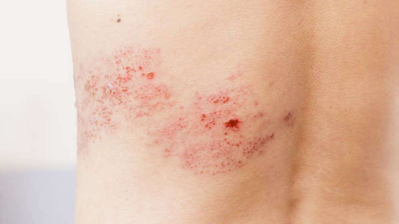 Así puedes identificar el Herpes Zóster: estos son sus principales síntomas