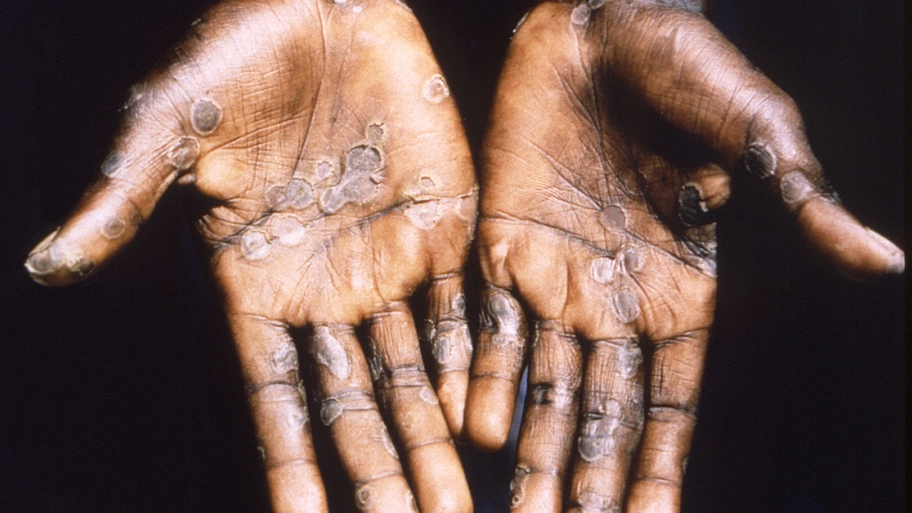 La OMS alerta de que la transmisión del virus mpox continúa, con casos en 26 países