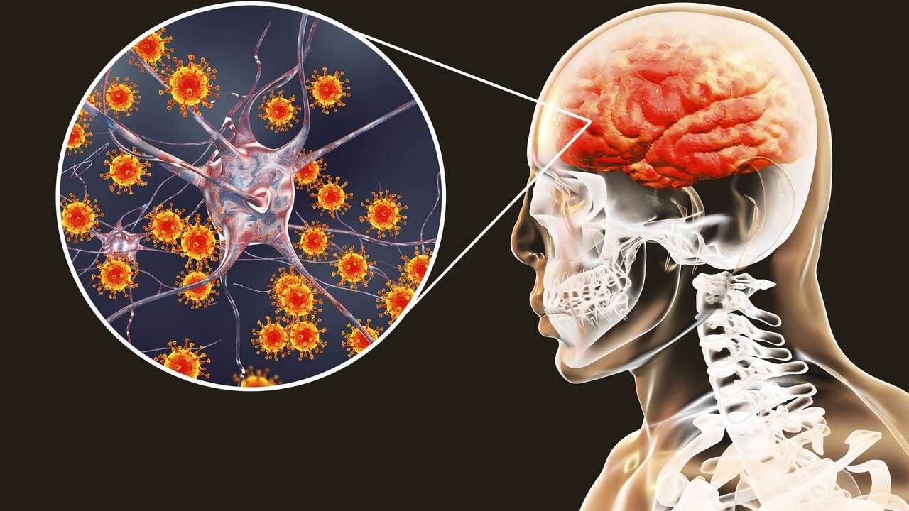 Los neurólogos alertan de que en los próximos años se pueden duplicar los casos de meningitis