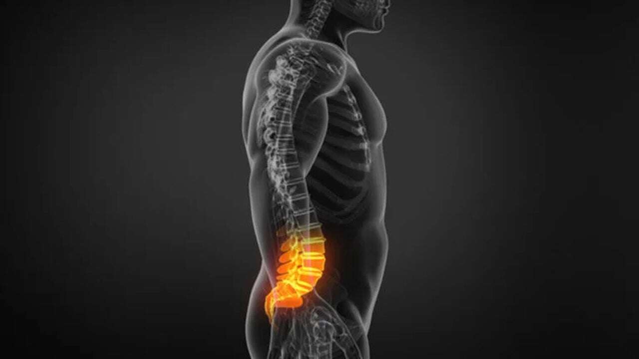 Descubren decenas de nuevos genes vinculados con la hernia discal lumbar