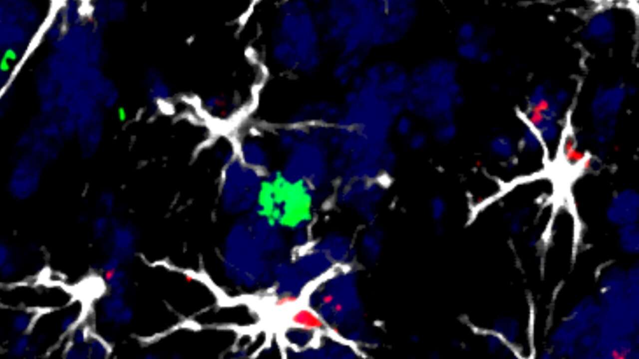 Desarrollan una linterna molecular para detectar metástasis en zonas profundas del cerebro