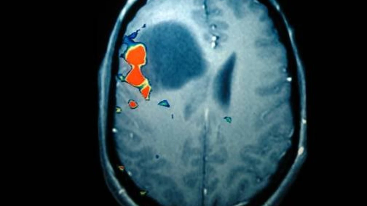 Investigadores encuentran relación entre sufrir un traumatismo en la cabeza con tumores cerebrales