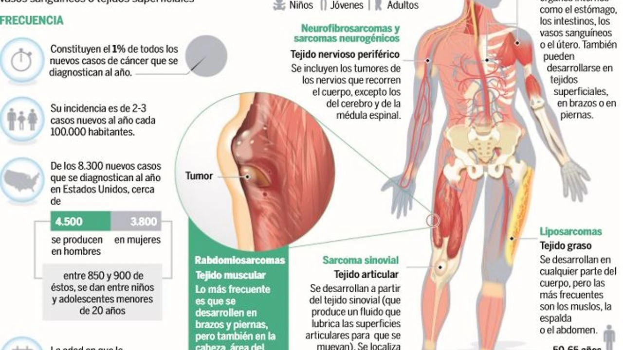 La terapia dirigida de precisión llega al tratamiento del sarcoma