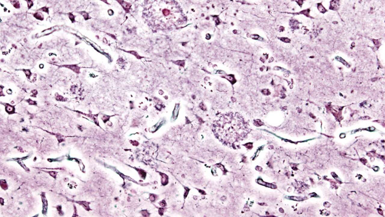 Identifican una nueva forma de Alzheimer que afecta a personas con dos copias de un gen