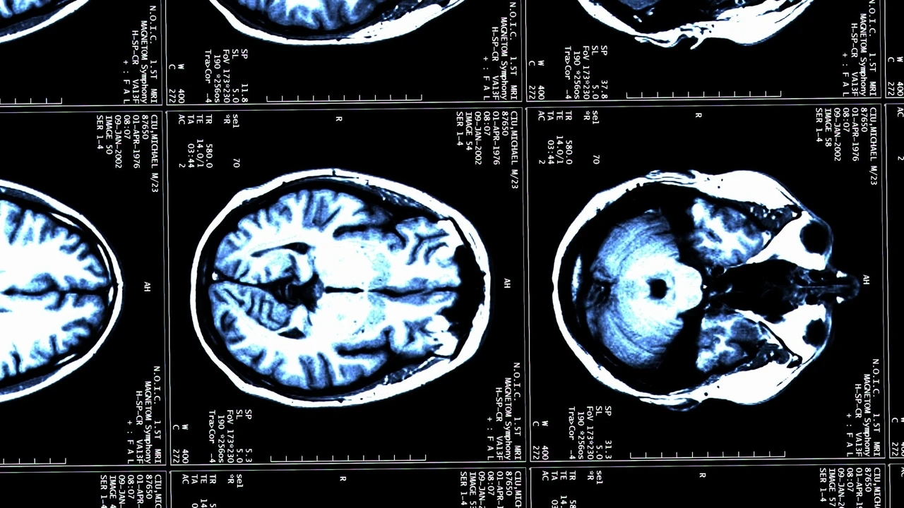 Reino Unido administrará una inyección para ralentizar la esclerosis múltiple