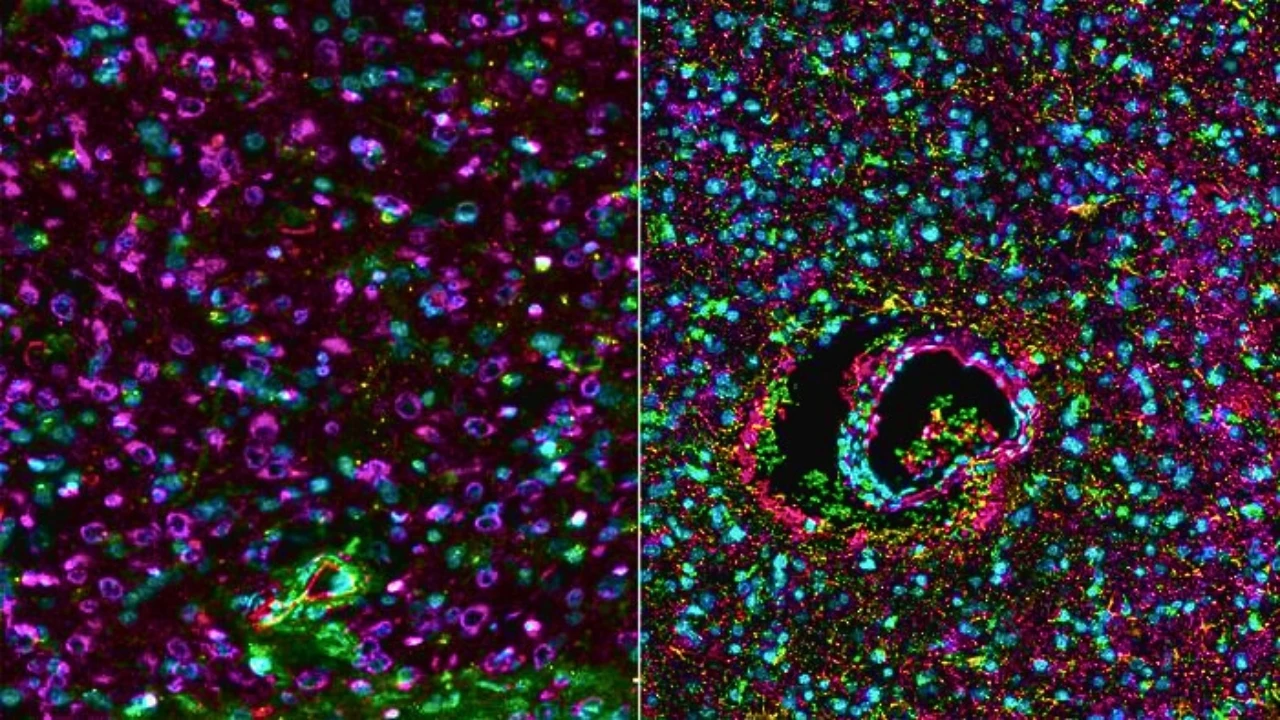 Ensayo clínico pionero revela avances sin precedentes para curar el cáncer cerebral