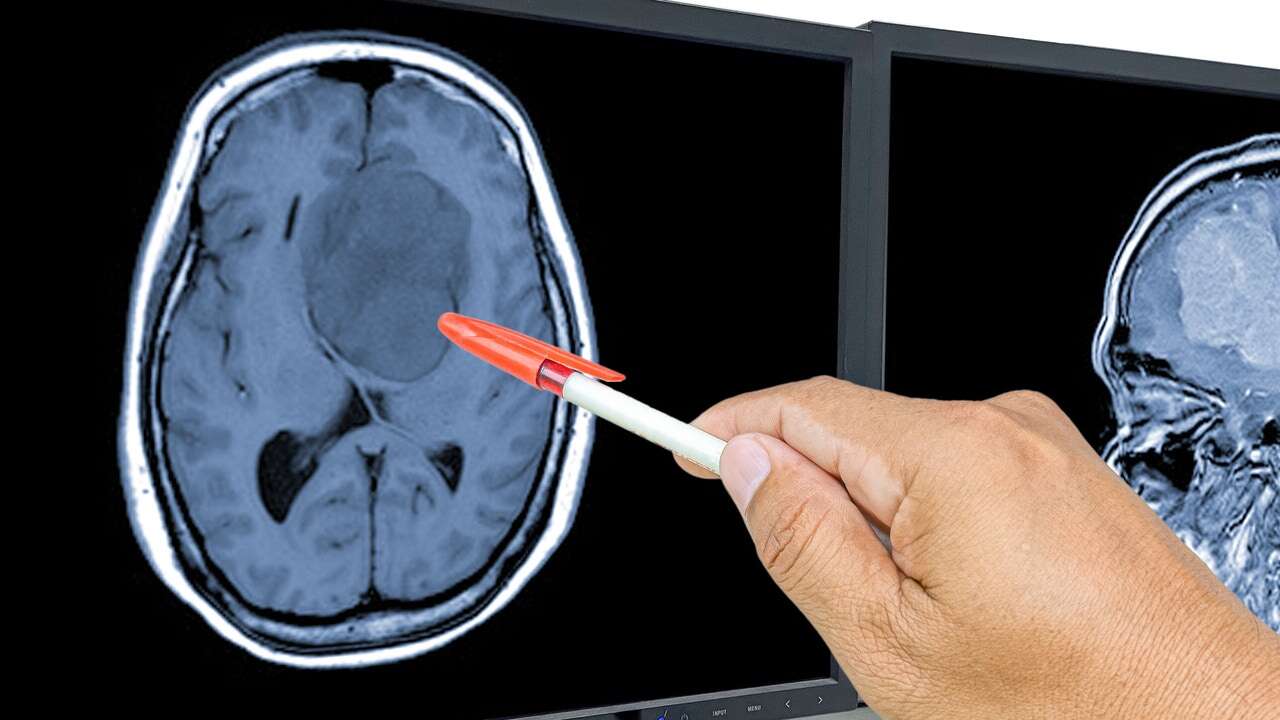 Investigadores españoles prueban un fármaco en personas con un tipo de tumor cerebral 