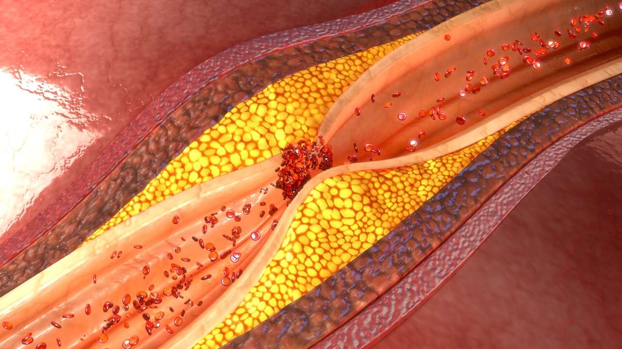 Una proteína impide la inflamación de las arterias