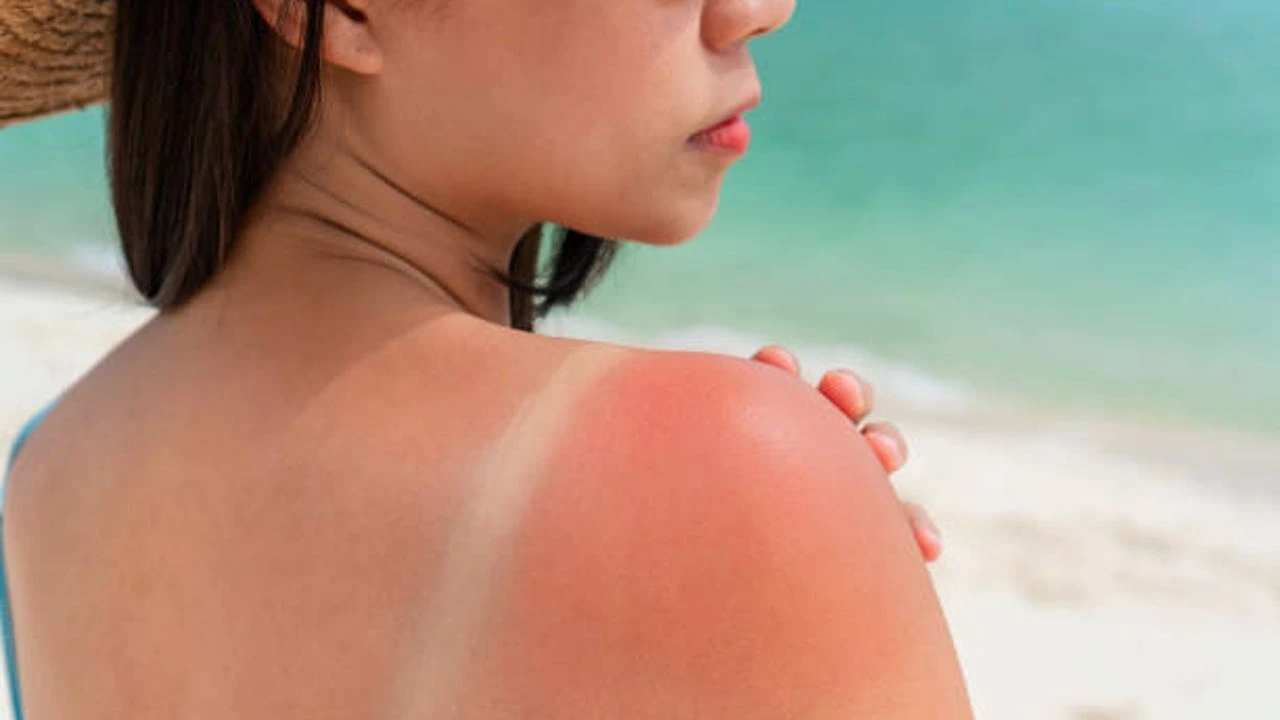 Cómo tratar las quemaduras producidas por el sol durante este verano