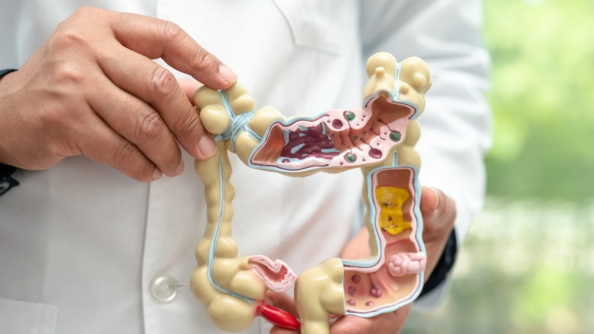 Cáncer colorrectal: sigue creciendo en 2026 sin síntomas en muchos casos