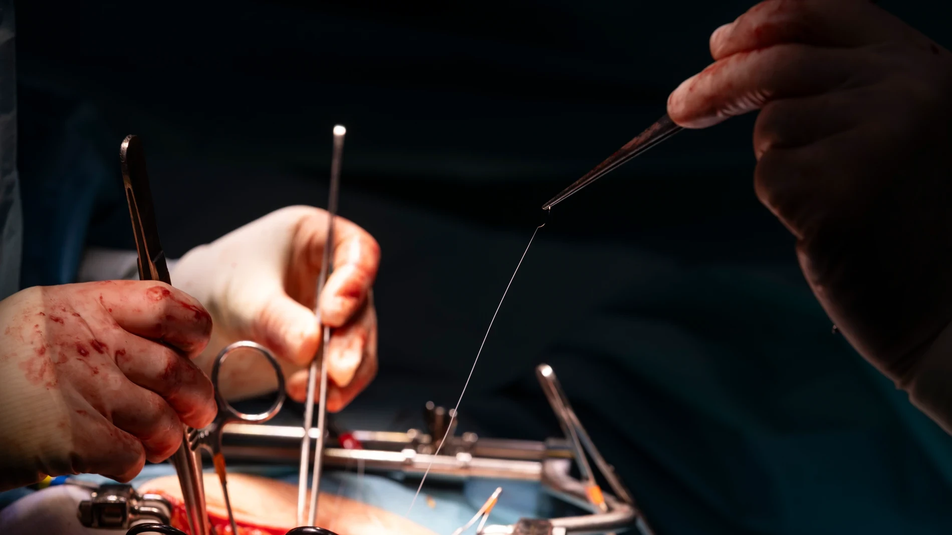 El hito de la donación hepática de vivo con cirugía robótica
