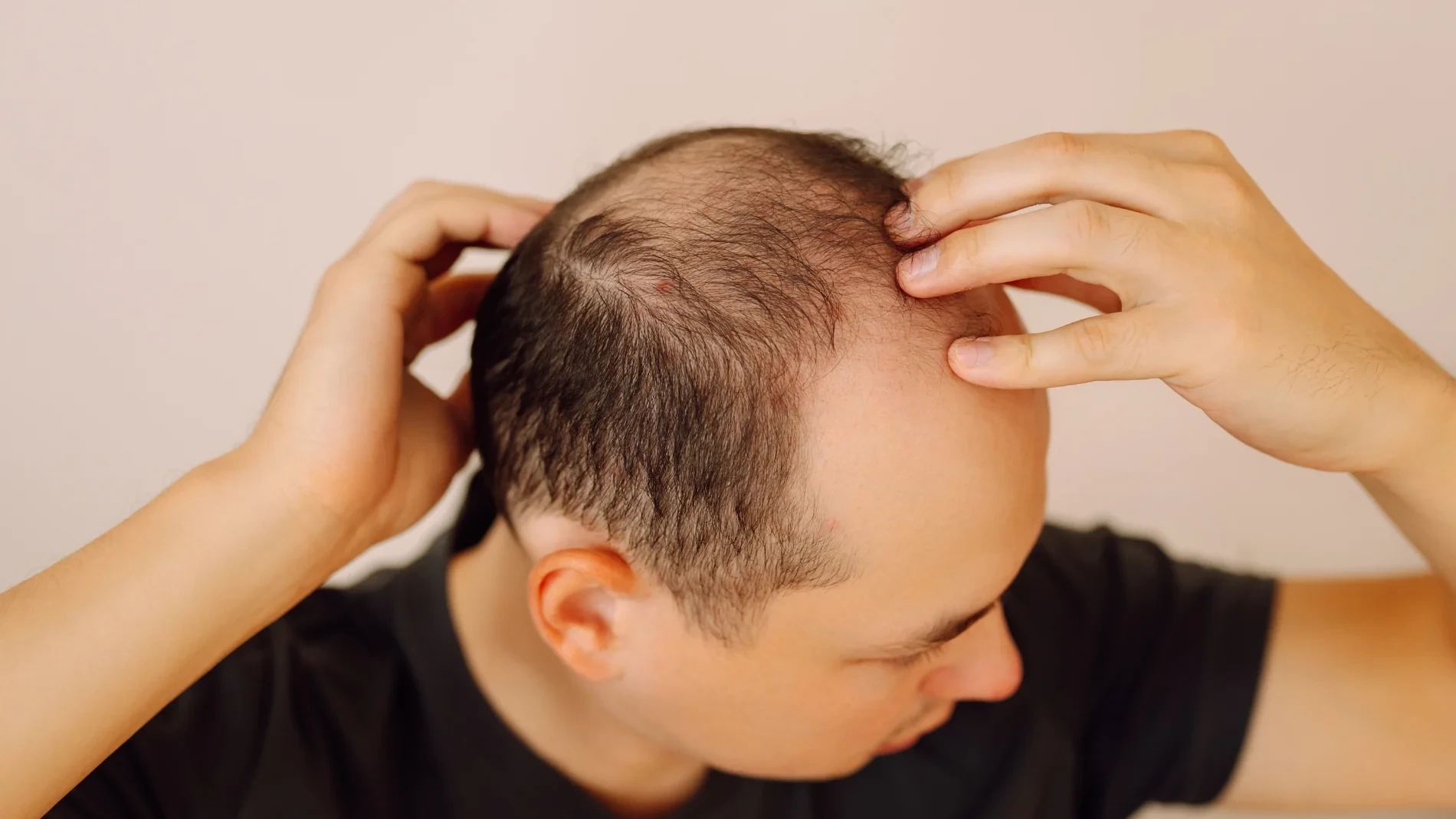 Un estudio revela la solución para combatir la calvicie: igual de efectivo que el minoxidil y más económico