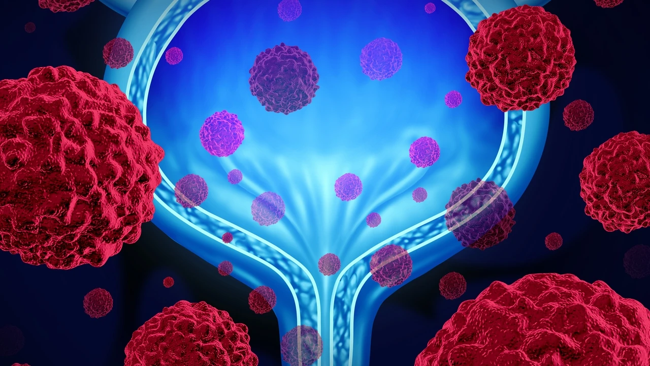 La biopsia líquida permitirá anticipar qué pacientes con cáncer de vejiga necesitarán inmunoterapia tras la cirugía y cuáles pueden evitarla