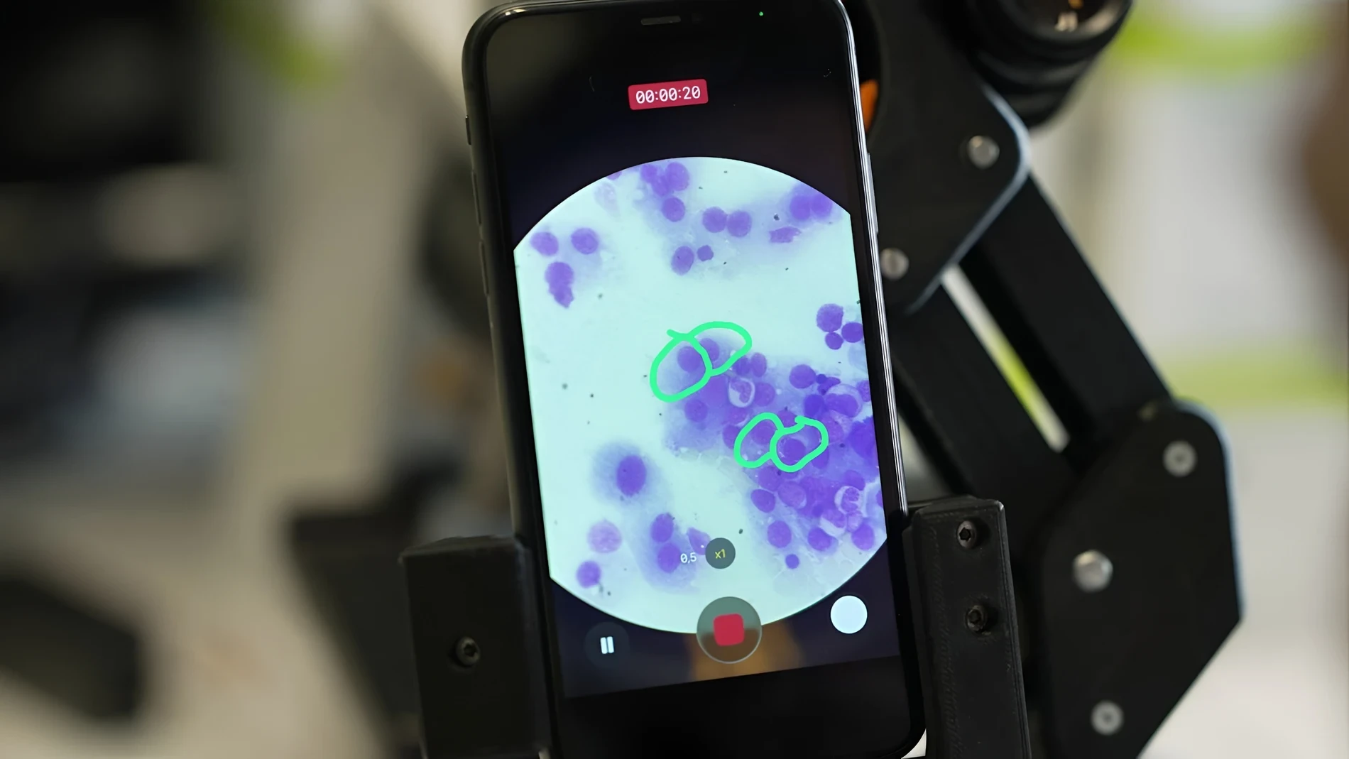 El uso de antibióticos reduce un 20% la supervivencia en pacientes con este cáncer