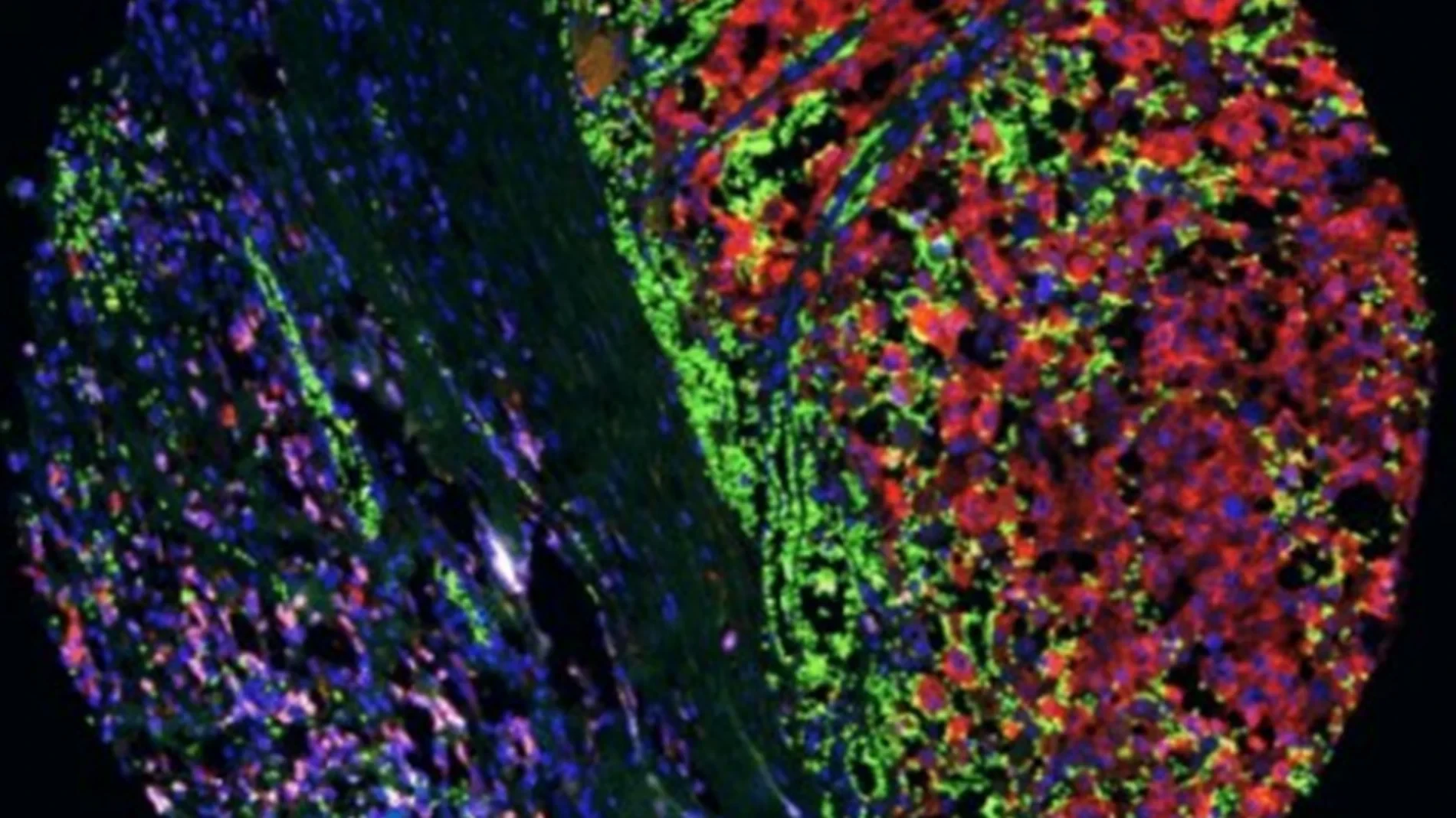 Científicos españoles dan con una nueva vía para reducir la metástasis del melanoma