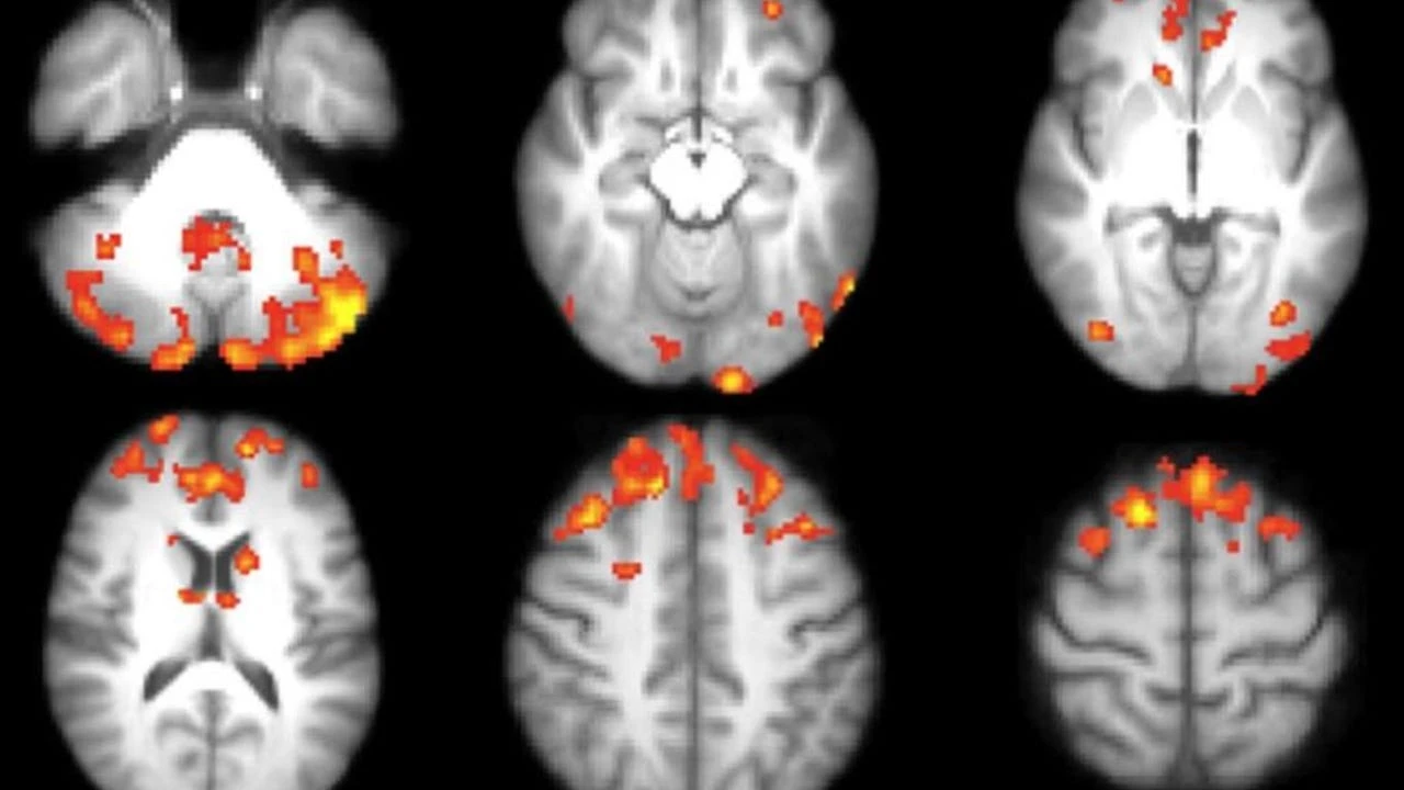 Un nuevo implante reduce la fatiga y los mareos en personas con lesiones de médula espinal
