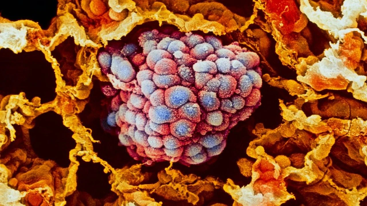 La reutilización de fármacos oncológicos, una alternativa al retraso en el acceso