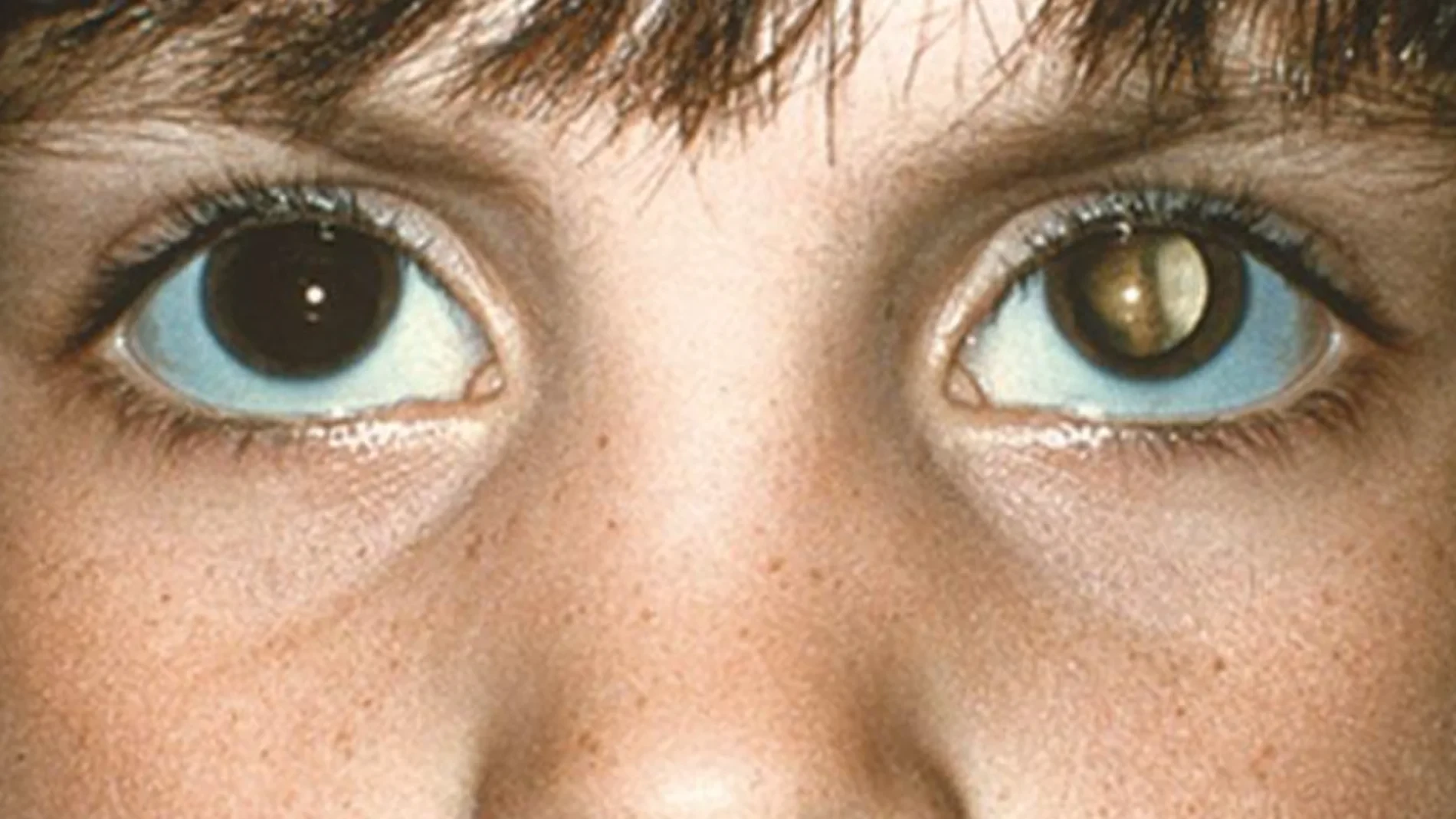 Utilizan un derivado del semen para tratar el retinoblastoma