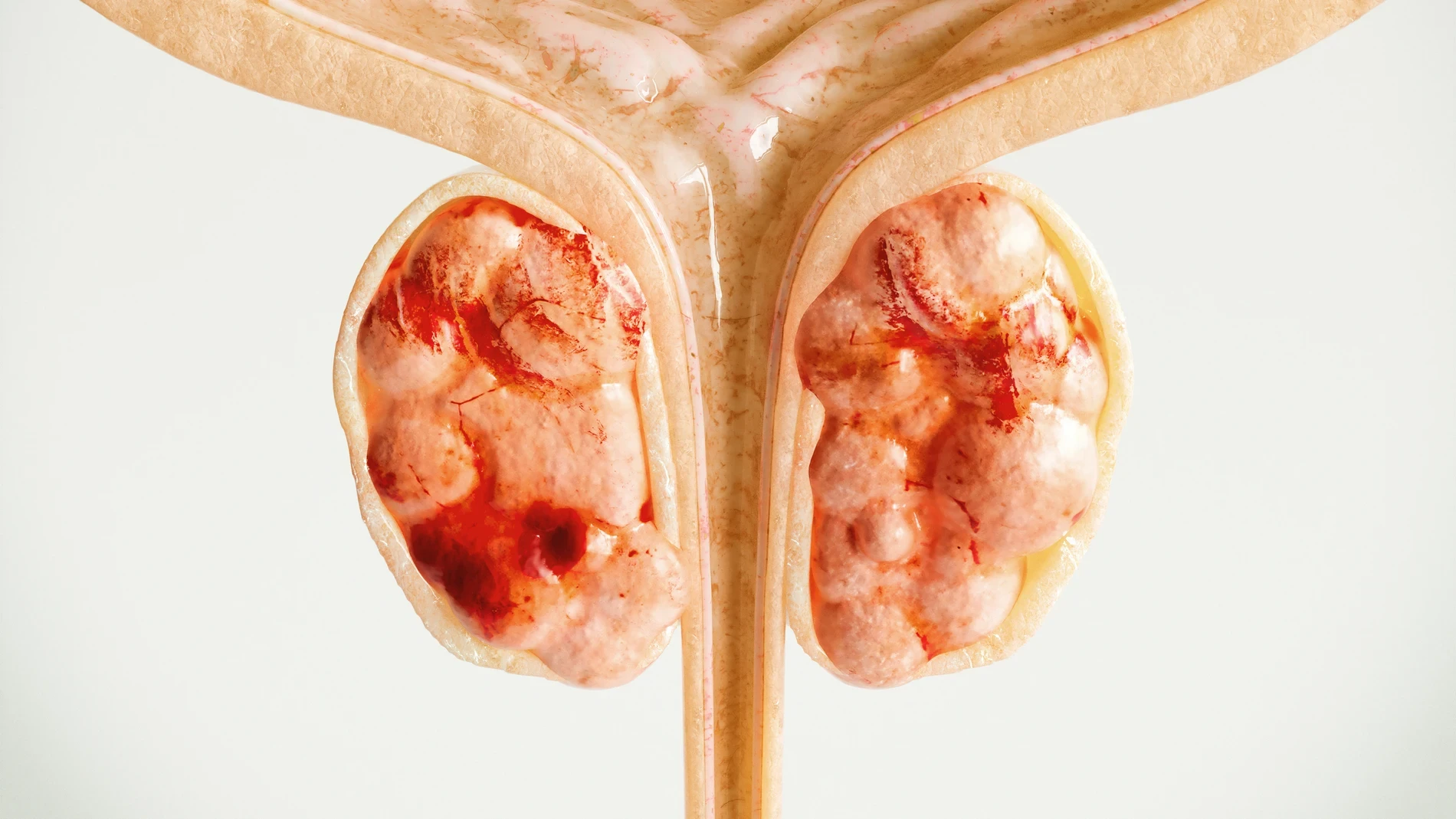 Revelan cómo detener la forma más letal del cáncer de próstata