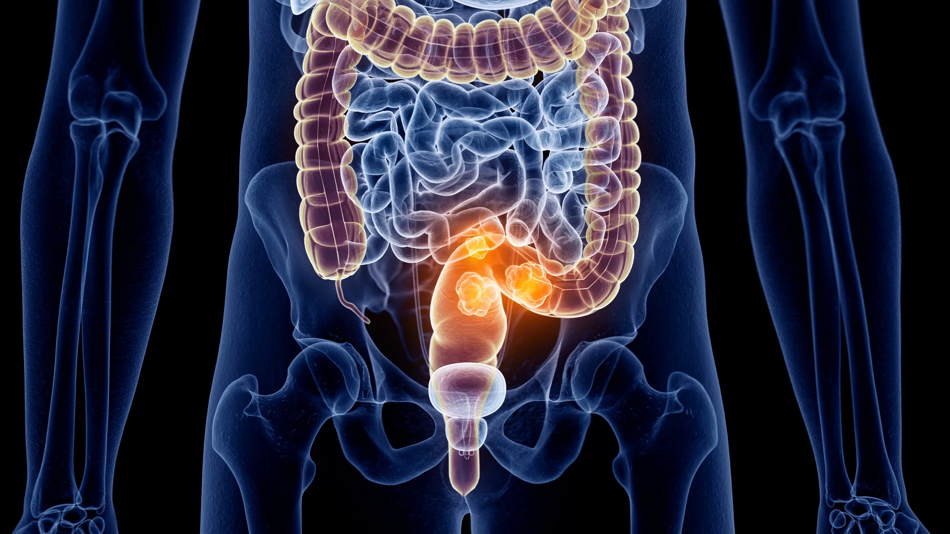 Claves para detectar cáncer colorrectal