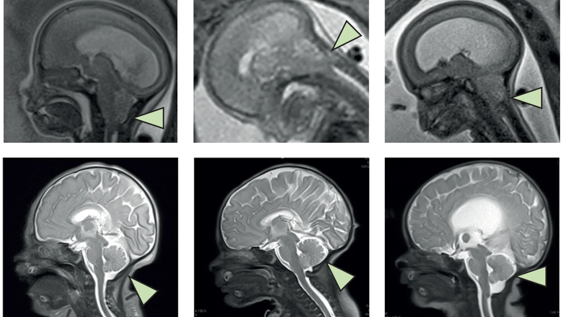Descubren una hormona en nuestro cerebro que revierte la obesidad