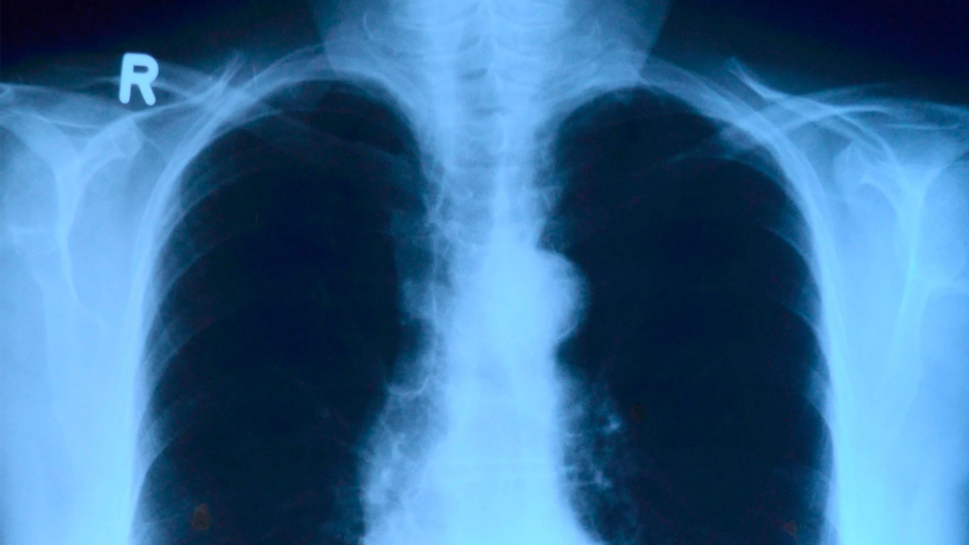 ¿Es posible usar donantes mayores de 70 años para el trasplante de pulmón? La ciencia lo aclara