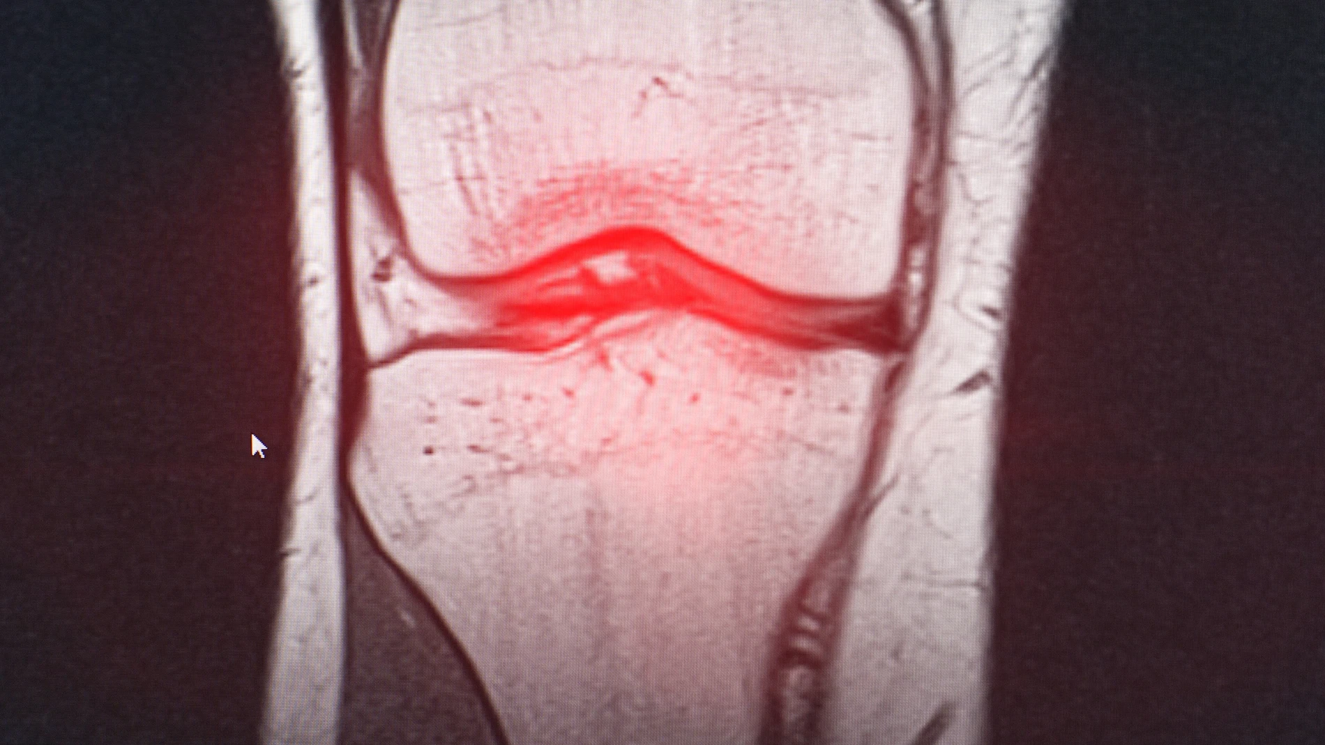 España, primer país en aplicar un innovador tratamiento para la artrosis de rodilla