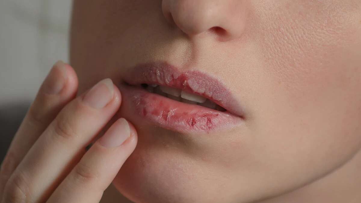 Cáncer de labio: qué es, cuáles son sus síntomas y cómo prevenirlo