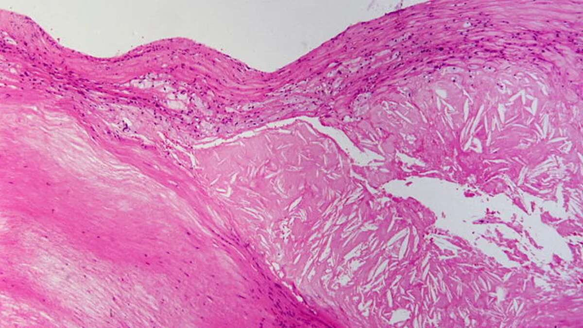 Un estudio advierte que el colesterol daña nuestras arterias mucho antes de lo que se pensaba