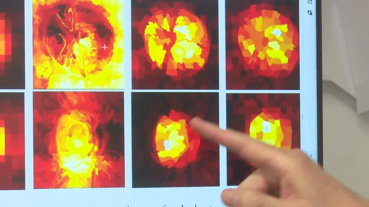 Un novedoso estudio detecta glaucoma con Inteligencia Artificial