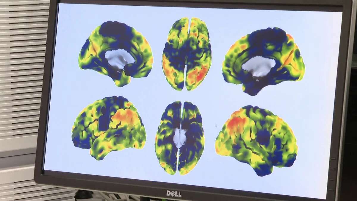 Un nuevo biomarcador permite identificar pacientes que desarrollarán párkinson antes de que aparezca