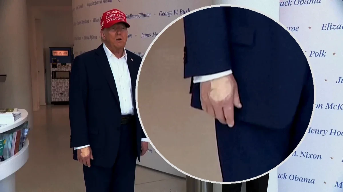 Una gruesa capa de maquillaje en la mano de Donald Trump aviva los rumores sobre su salud