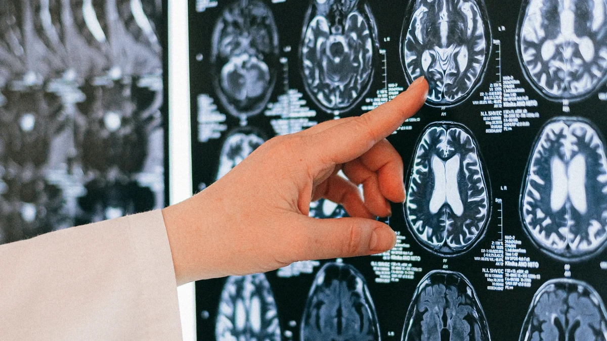 Detectan alteraciones cerebrales tempranas en adolescentes con trastorno límite de la personalidad