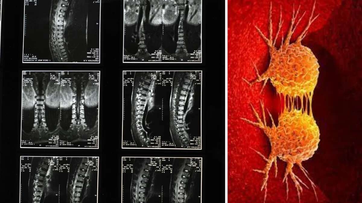 Denuncia que su madre murió después de que los médicos confundieran el cáncer con una lumbalgia