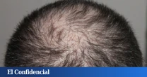 Un nuevo tratamiento capilar realmente hace crecer el pelo en dos semanas, dice un estudio