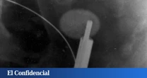 Eliminar los cálculos renales sin dolor ni efectos secundarios podría estar más cerca que nunca gracias a este gel magnético