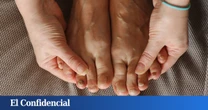 ¿Cómo eliminar hongos de las uñas de los pies rápidamente?
