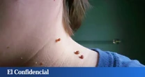 ¿Cómo quitar una verruga? Remedios y productos que necesitas