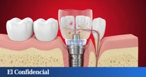 Crean nuevos implantes dentales que 'crecen' en tu boca como los dientes reales