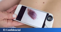 El Hospital público Universitario Rey Juan Carlos consolida su experiencia en cirugía de Mohs