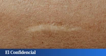 Australia podría haber creado una crema que elimina las cicatrices permanentes de la piel
