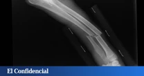 Hay algo en lo más profundo de los huesos que no debería estar ahí. Y puede causar fracturas y deformaciones