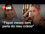 Mulher sofre AVC enquanto corria e tem parte do crânio removido: 'Senti uma dor estranha'