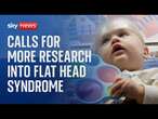 Calls for more research into flat head syndrome in babies and whether helmet therapy works